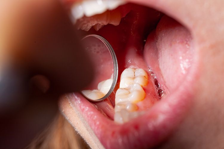 caries en el diente