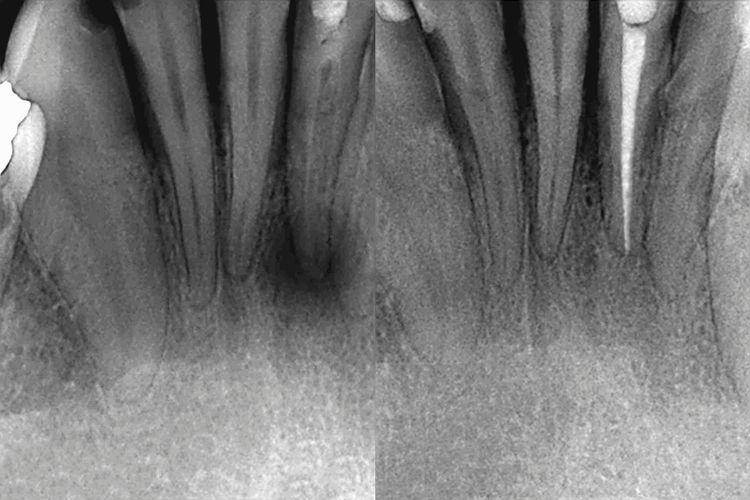 antes y despues de endodoncia