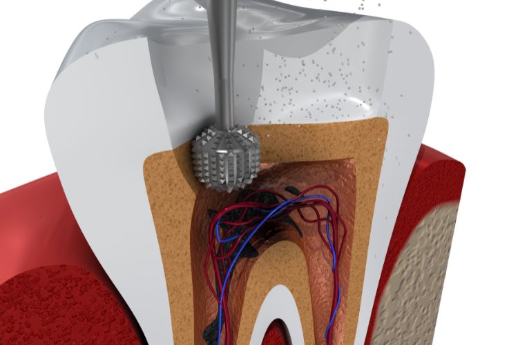 endodoncia de un diente