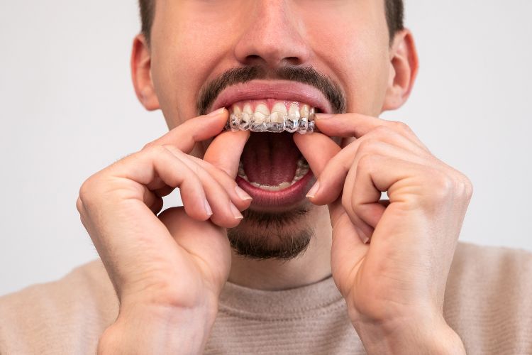 ponerse ferulas de invisalign en la arcada superior