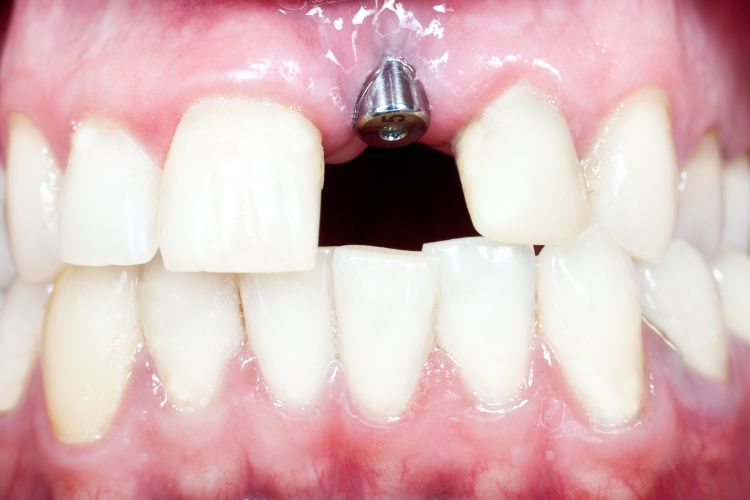 implante dental