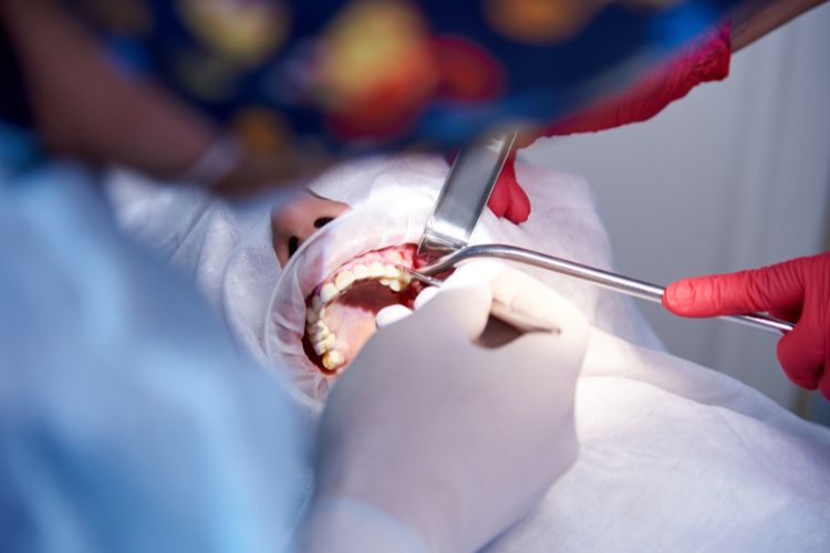 integracion de hueso e implante dentista