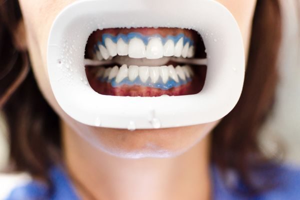 blanquemiento-dental-clinica blanqueamiento dental clinica